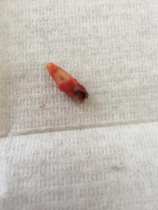 The tooth I extracted 